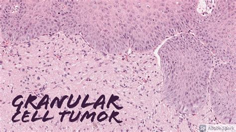 Granular Cell Tumor Histology