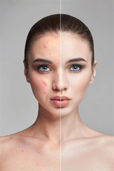 Premium Photo | Pimples and acne on woman face before and after | Acne, Pimples under the skin ...