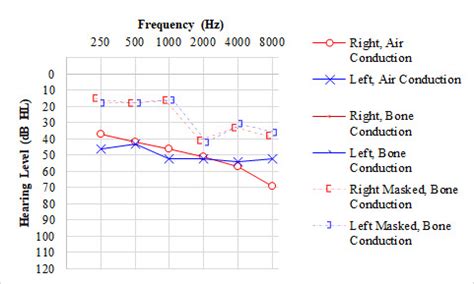 [Figure, Audiogram, Otosclerosis. An audiogram showing...] - StatPearls - NCBI Bookshelf