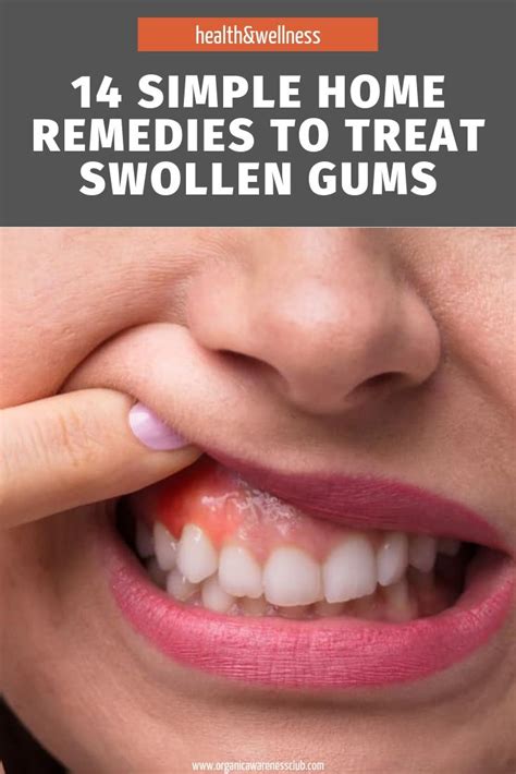 14 Simple Home Remedies To Treat Swollen Gums | Swollen gums remedy ...