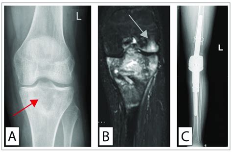 Osteosarcoma treated with extraarticular knee resection and ...