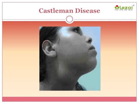 Castleman Disease