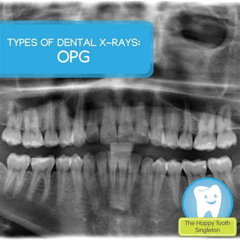 Types of dental x-rays – OPG | The Happy Tooth Singleton