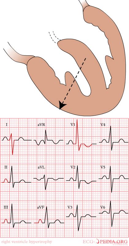 Electrocardiographic findings in right ventricular hypertrophy - wikidoc