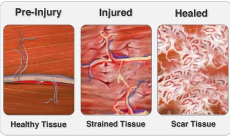 What Is Scar Tissue, and How Do I Get Rid of It? | The Pain & Injury Doctor