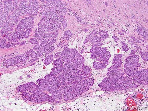 Carcinoid Tumor of Lung