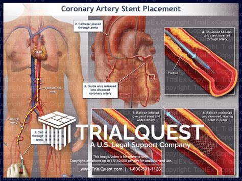 Coronary Artery Stent Placement - TrialExhibits Inc.