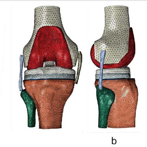 Simulated implantation of TKA prosthesis. a 3D model of the knee joint;... | Download Scientific ...