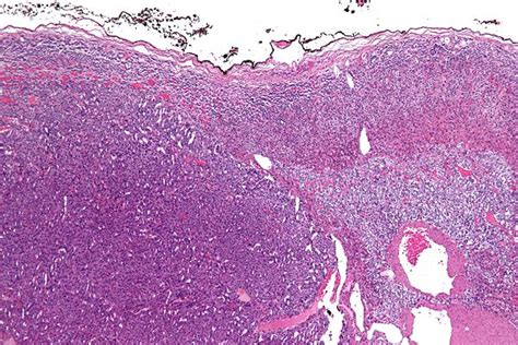 Adrenocortical carcinoma - Wikipedia