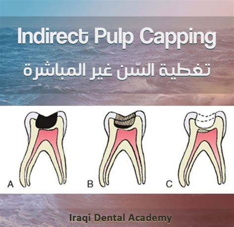 Indirect Pulp Capping Procedure