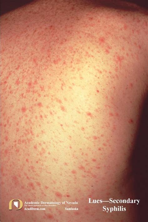 Secondary Syphilis (Lues): It looks like Pityriasis Rosea...but it's not... - Academic ...