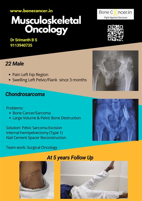 Chondrosarcoma - BoneCancer.in Chondrosarcoma:Limb Salvage Surgery