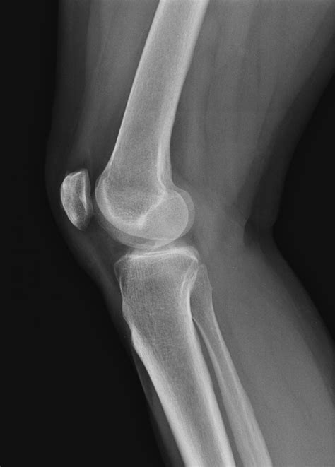 NORMAL KNEE 2 | Buyxraysonline