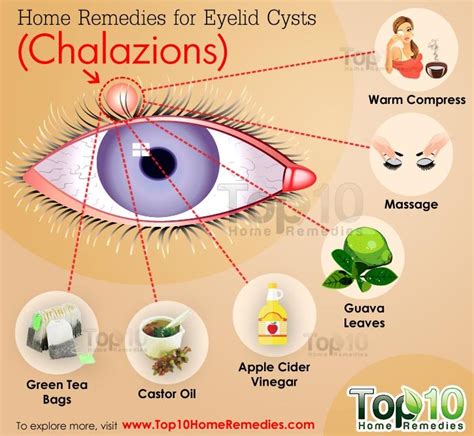 Home Remedies for Eyelid Cysts (Chalazions) | Top 10 Home Remedies