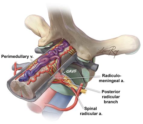 Spinal AV Fistula Disconnection | The Neurosurgical Atlas, by Aaron Cohen-Gadol, M.D.