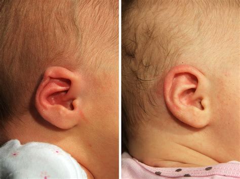 Parents Choose A Simple Device To Reshape A Baby's Ear | NCPR News