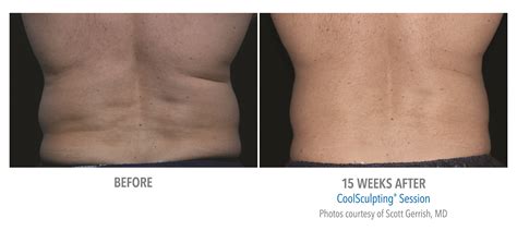 CoolSculpting · Laser Advantage