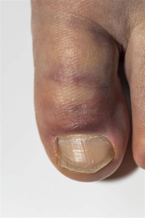 Close Up View of a Man with an Injured Big Toe. Injury Concept Stock Image - Image of bruise ...