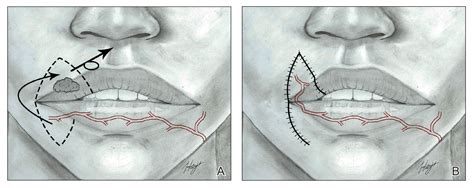 Upper Lip Anatomy, Mechanics of Local Flaps, and Considerations for ...