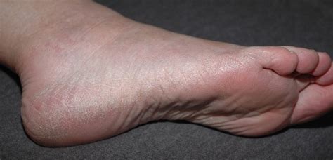 Itchy Feet - Causes and Cures Part 2 - Podiatry HQ