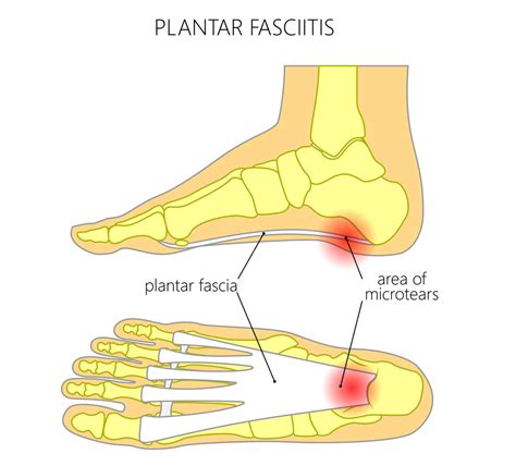 Foot Anatomy Plantar Fasciitis