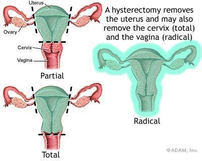 Symptoms Of Pregnancy After Partial Hysterectomy