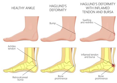 About Haglund's Deformity - Caruso Foot & Ankle