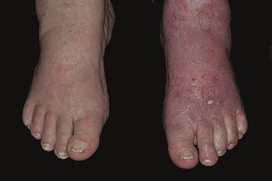 Case report: Cellulitis and underlying fungal infection | MIMS online