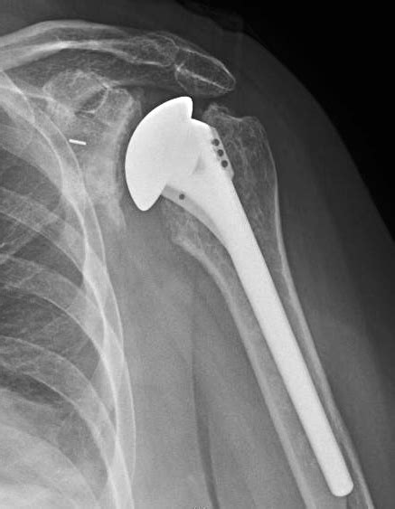 UW Shoulder and Elbow Academy: Total shoulder arthroplasty for severe ...