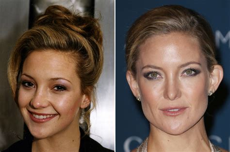 Celebrity Nose Jobs - Before & After - Irish Mirror Online