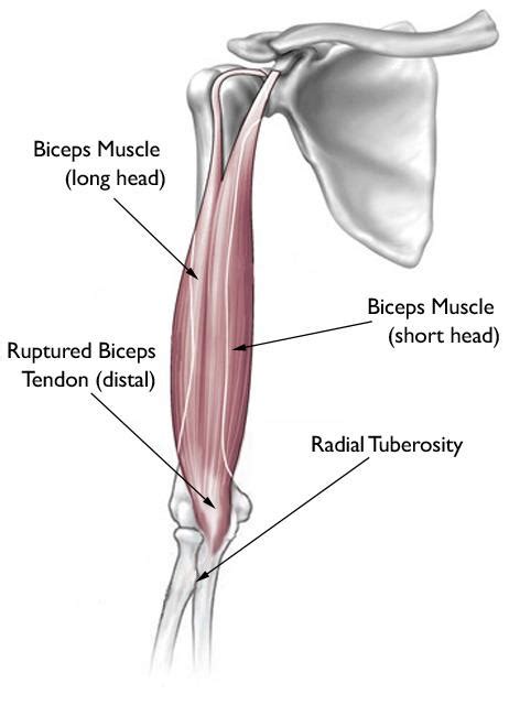 Injections for Distal Bicep Tendon | Steroid Injections For Biceps Pain ...