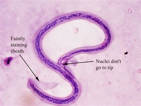 Penyakit Filariasis | TES DARAH LENGKAP