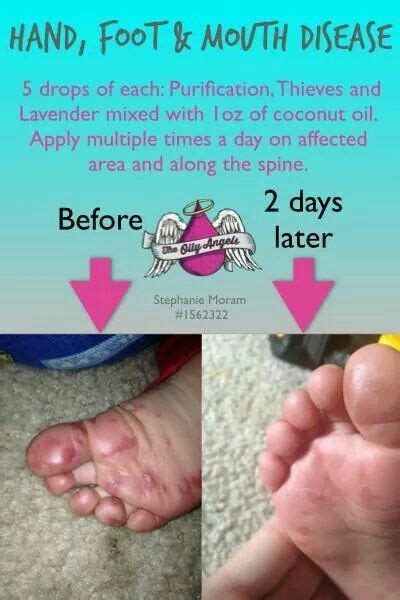 Hand, Foot, & Mouth Essential Oil Remedy, Essential Oils Health, Essential Oil Uses, Essential ...