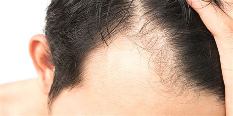 Alopecia Areata Hair Loss Treatment | Norris Dermatology Portland OR