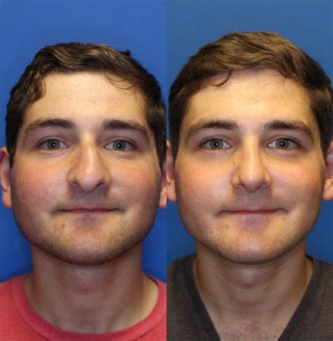 Nose Surgery Before & After Photos Patient 224 | San Francisco, CA | Kaiser Permanente Cosmetic ...