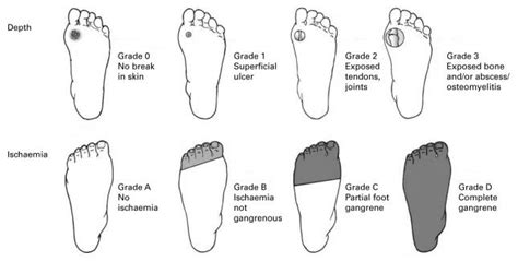 Diabetic Foot Ulcers - Foot & Ankle - Orthobullets