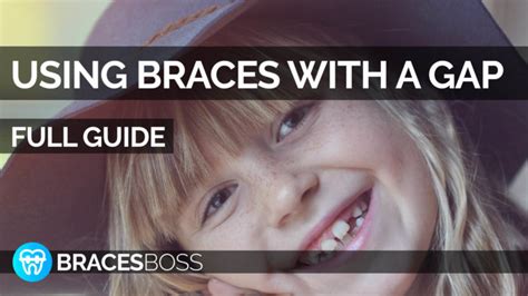 Braces for Gap Teeth - Full Pro Guide 2024 - BracesBoss