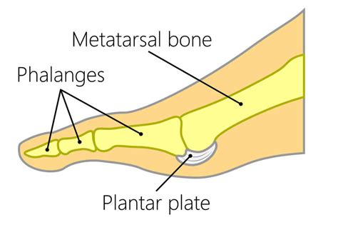 Podiatry Centre for Plantar Plate Tear in Singapore