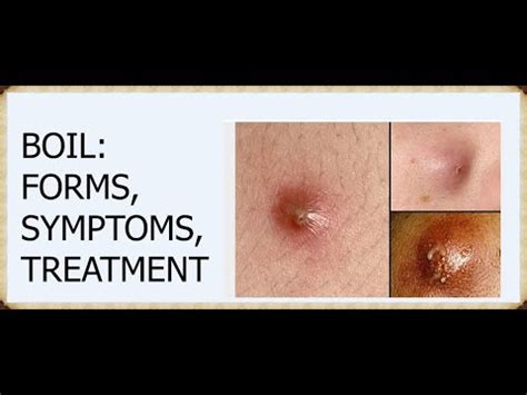 What Is a Boil,FORMS,SYMPTOMS,TREATMENT - YouTube