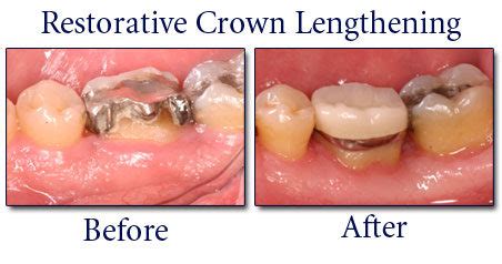 Crown Lengthening | DMS Dentistry