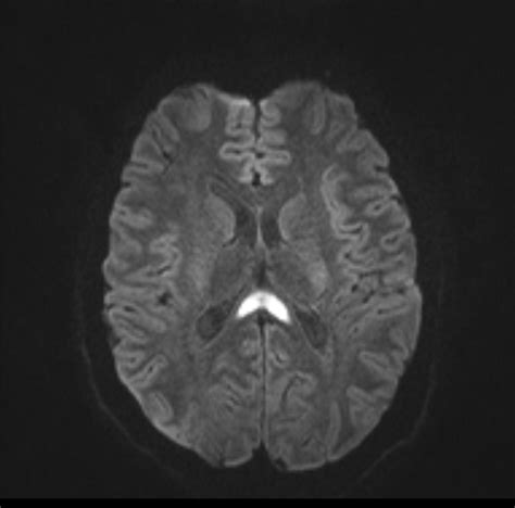 Transient lesion of the splenium | Image | Radiopaedia.org