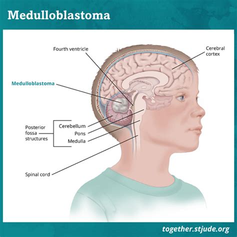 Posterior Fossa Syndrome - Together by St. Jude™