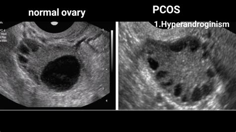 Follicle Detection And Ovarian Classification In Digital, 60% OFF