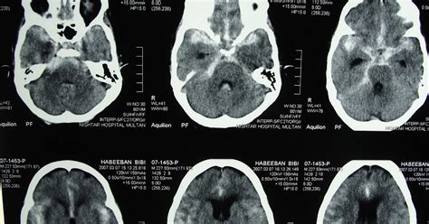 Health Updates: CT scan for assessment & Diagnosis case 06