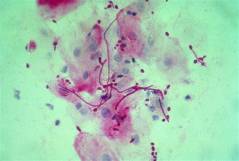 Candida albicans (Pathogenesis) - microbewiki