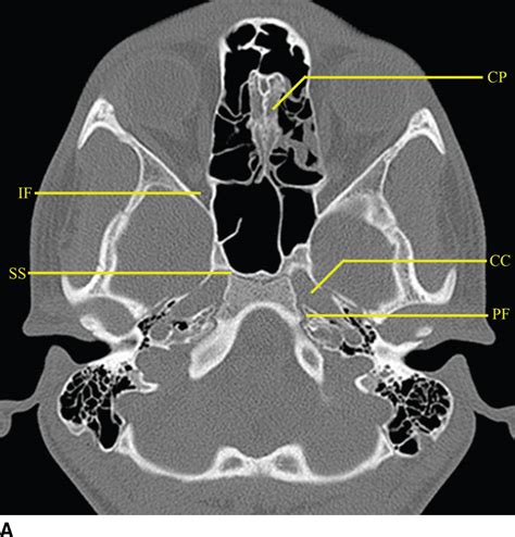 Ventral and Central Skull Base: Sinonasal, Sellar, Parasellar, and Orbit Regions | Radiology Key