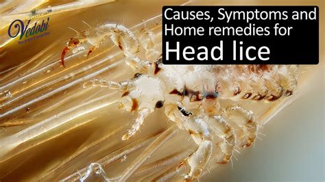 Vedobi - Causes, Symptoms and Home remedies for Head lice