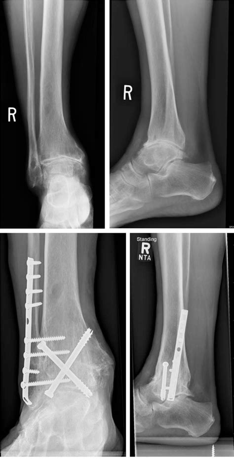 ankle fusion | Semantic Scholar