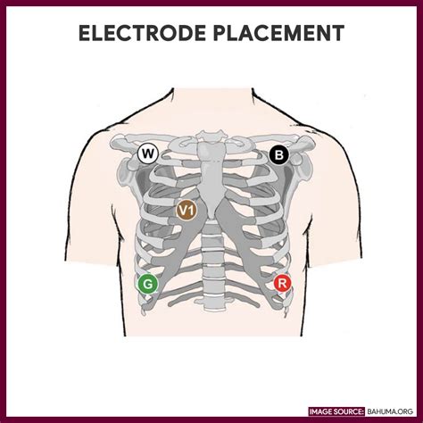 Holter Monitoring - Nursing Responsibilities and Care Plan - Nurseslabs