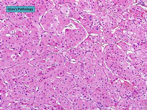 Renal Cell Carcinoma Histology